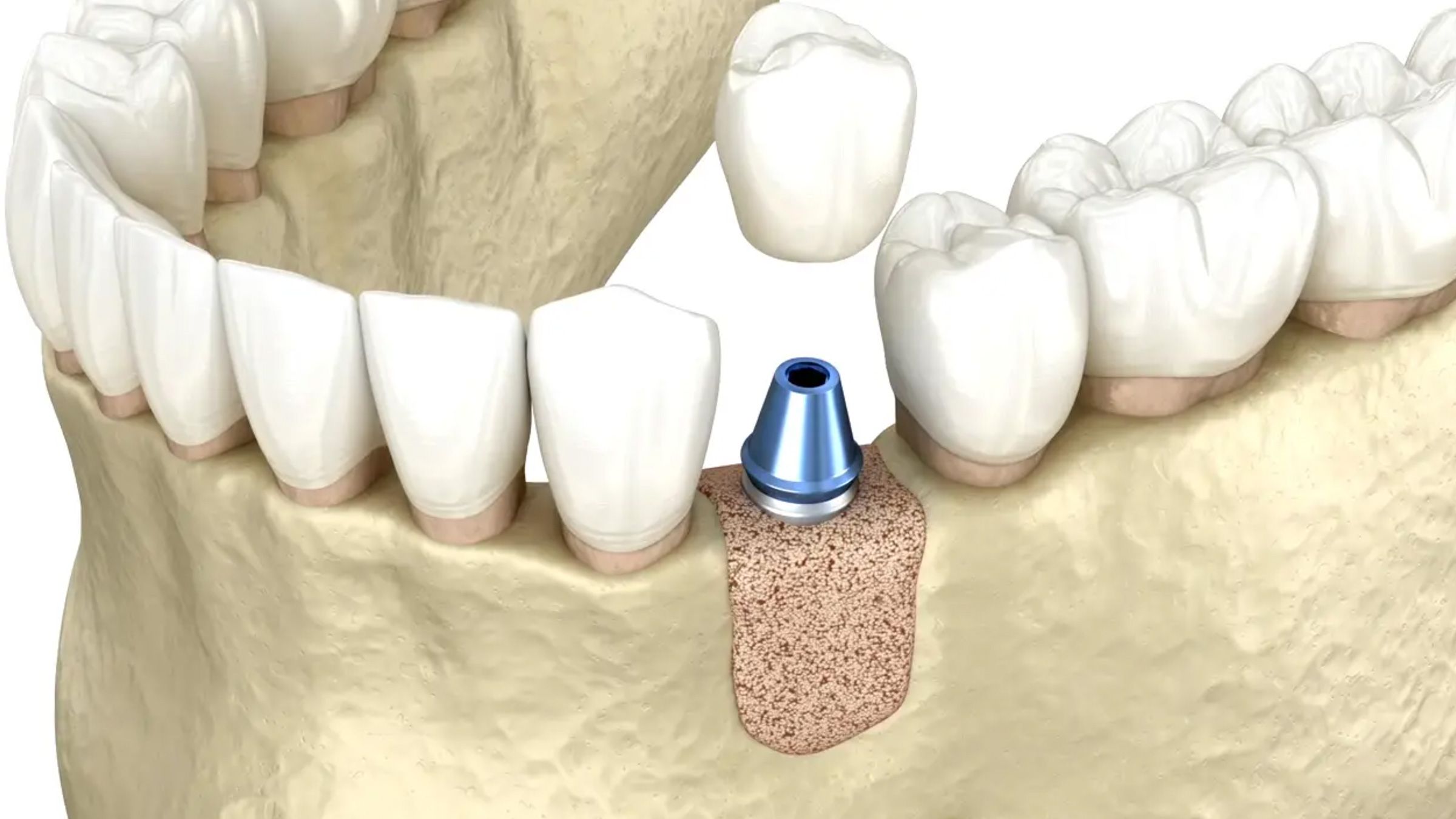 Bone Graft Video