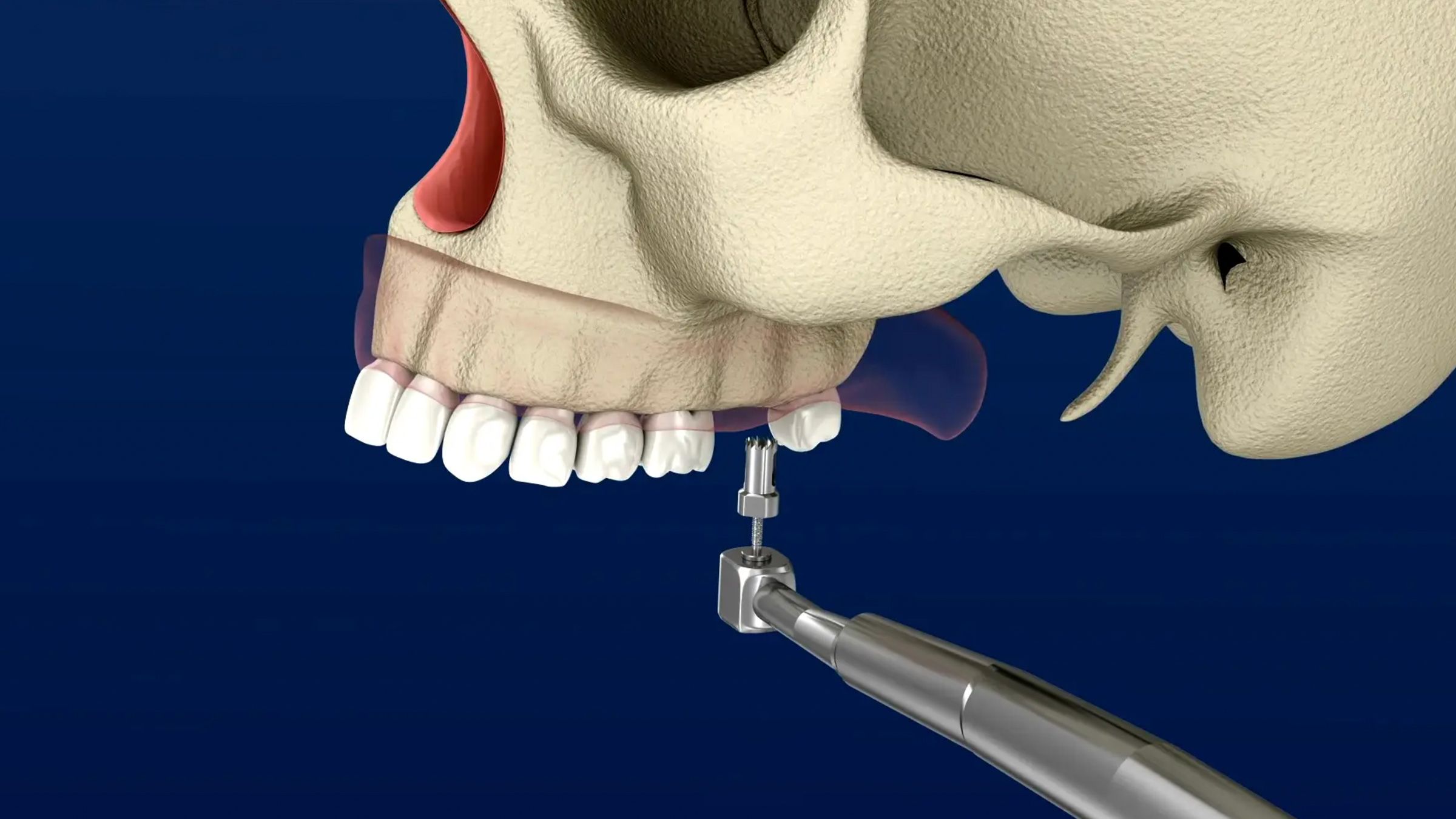 Sinus Lift Video